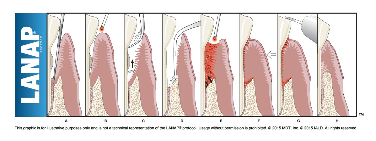 What Is LANAP Protocol? Preserve Your Teeth DentistryPreserve Your Teeth